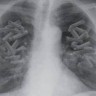 Cientistas descobrem que câncer de pulmão pode se ocultar durante 20 anos